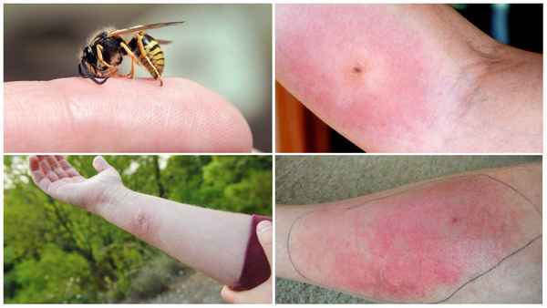 Укусы насекомых и лечение народными средствами + фото на коже человека кто как укусил